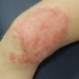Cellulitis