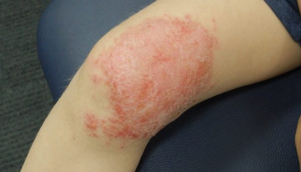 Cellulitis