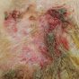 ep 7. Cellulitis