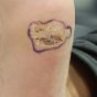 ep 8. Plantar and cutaneous warts