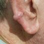 ep 9. JT - consented - keloid scar (use this one instead)